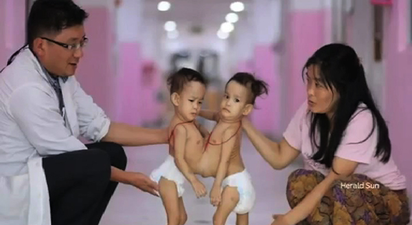 bhutan s first conjoined twins in australia for separation surgery