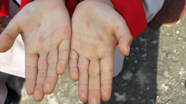Hand Foot and Mouth disease reported in Monggar