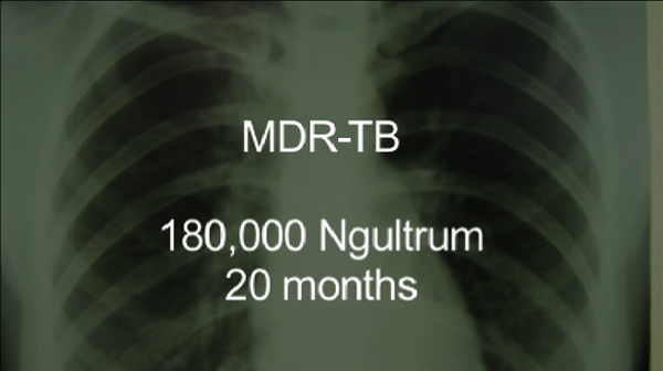 Number of Multi-Drug Resistant Tuberculosis increases