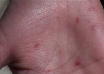 Hand, foot and mouth disease outbreak in Thimphu