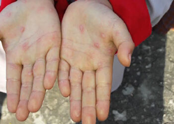 Hand, Foot and Mouth disease reported in Monggar
