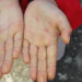 Hand, Foot and Mouth disease reported in Monggar