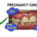 Poor practise of oral hygiene among pregnant mothers, research finds