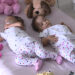 Conjoined twins recovering well after separation surgery