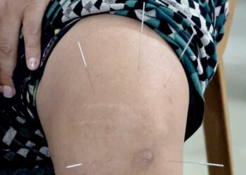 Overwhelming turnout at acupuncture camp in Gelephu